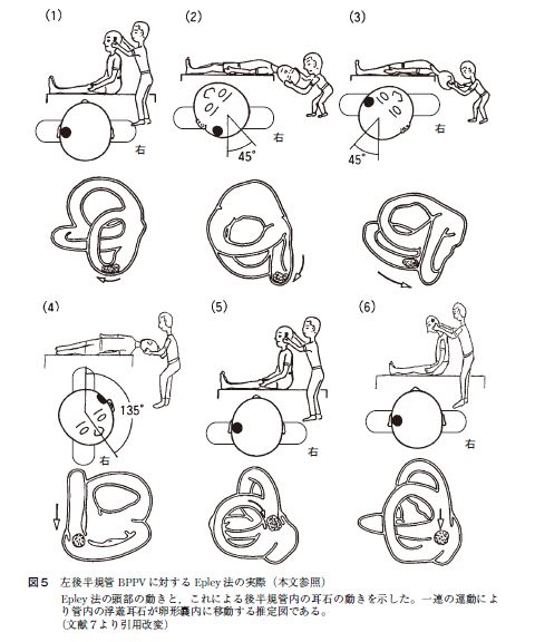 良性発作性頭位変換めまい
