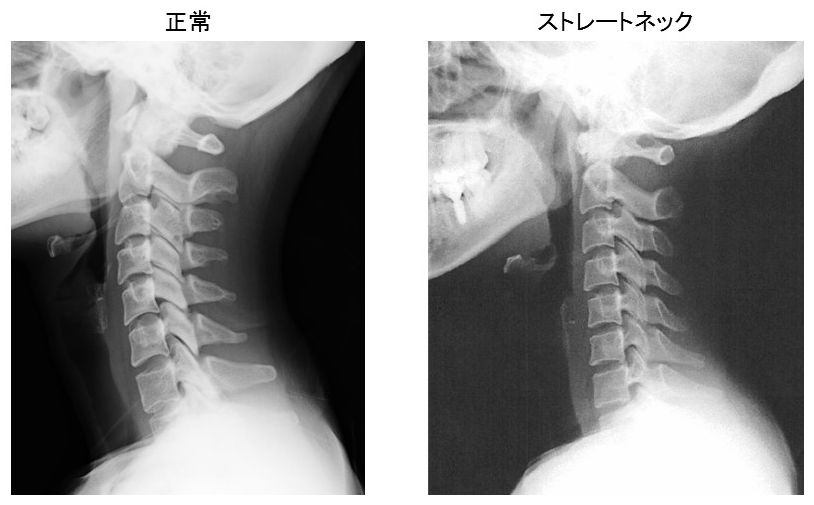 ストレートネック – WEB脳神経外科