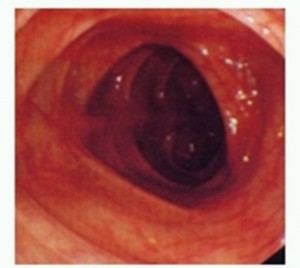 通常の大腸粘膜