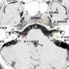 小脳橋角部の正常解剖　MRI CISS画像より