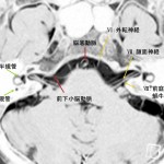 小脳橋角部の正常解剖　MRI CISS画像より
